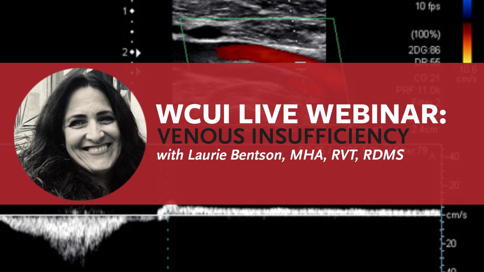 Live Webinar on Venous Insufficiency with Laurie Bentson